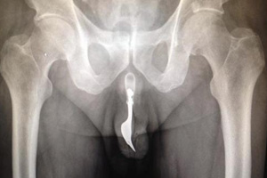 1376549759287-gabel-in-penis.jpg